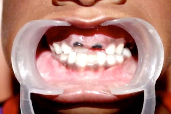 7 yaşındaki çocuğun ağzından 526 diş çıktı! galerisi resim 5