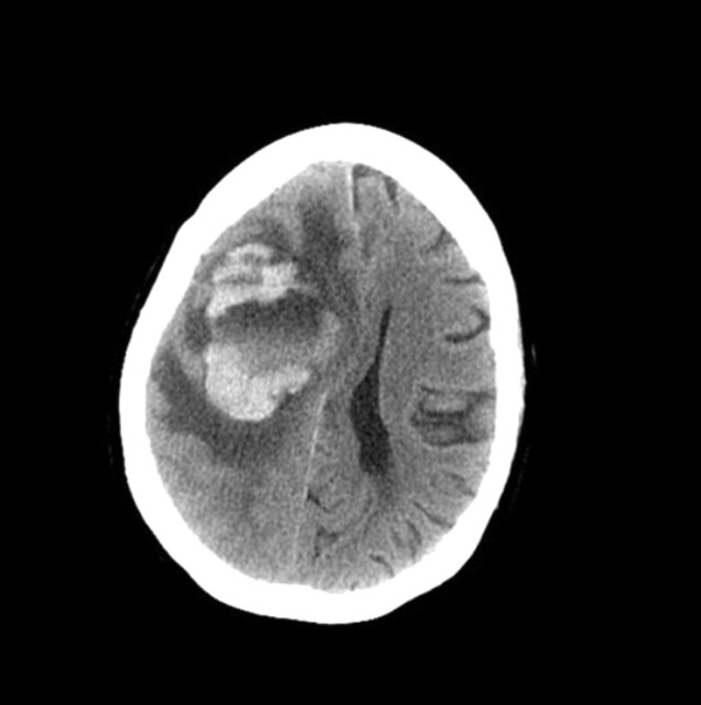 Burnunu Çeşme Suyuyla Temizleyen Kadının Beynini Amipler Yedi galerisi resim 8