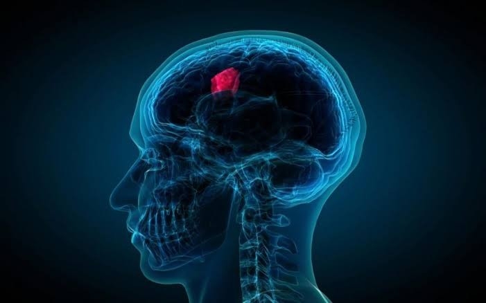 Beyin tümörünün belirtileri nelerdir? galerisi resim 2