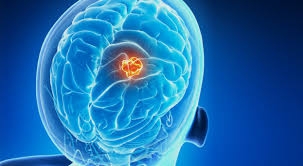 Beyin tümörünün belirtileri nelerdir? galerisi resim 4