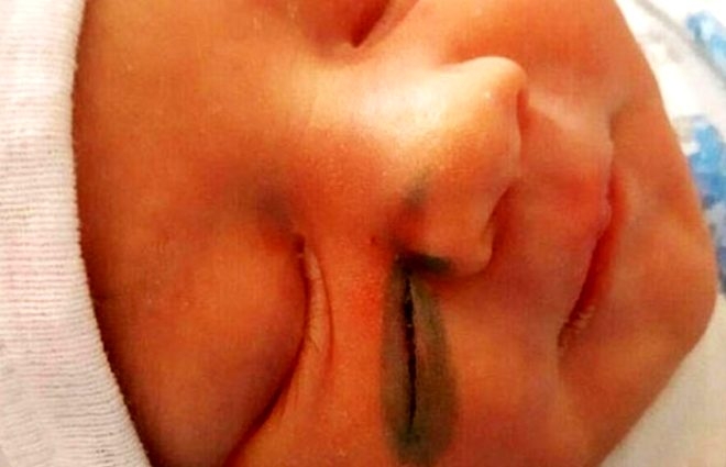 Akılalmaz hata! Doktorlar doğum sırasında bebeğin yüzünü kesti galerisi resim 6