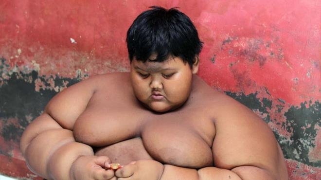 Dünyanın en şişman çocuğu 110 kilo verdi galerisi resim 4