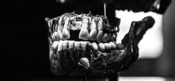 Τα δόντια δεν εμφανίζονται μόνο στο στόμα!  γκαλερί φωτογραφιών 1η φωτογραφία