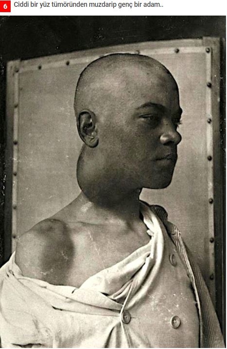 19.yüzyıldan'dan arşivdeki hastalık fotoğrafları galerisi resim 12