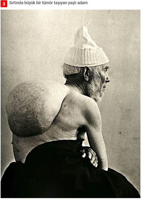 19.yüzyıldan'dan arşivdeki hastalık fotoğrafları galerisi resim 3