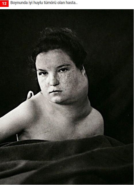 19.yüzyıldan'dan arşivdeki hastalık fotoğrafları galerisi resim 9