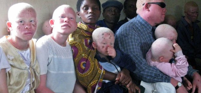 Senegal'de Albinosların Yüzde 98'i Kanser