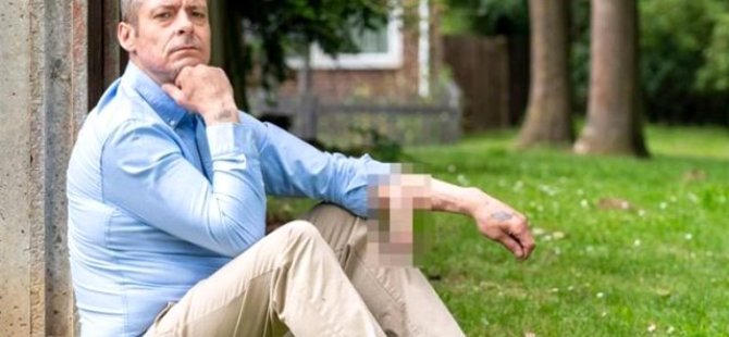İngiltere'de bir adam 4 yıldır kolunda cinsel organıyla yaşıyor