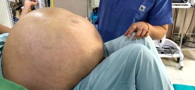 Hindistan'da Bir Kadından 54 Kilogram Tümör Çıkarıldı