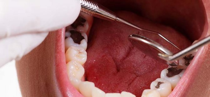Diş Çürüklerinden Kurtulmak İçin 10 Adım