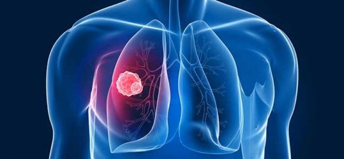 Akciğer Kanseri Cerrahisinde Tek Ve Küçük Kesiden Ameliyat Yapılıyor