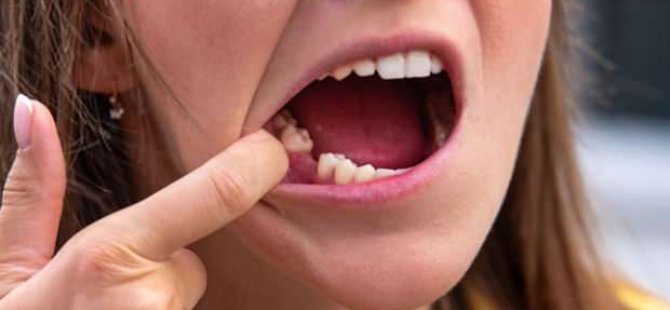 Korona Hastalarında Yeni Bulgu! Dişlerinize Dikkat