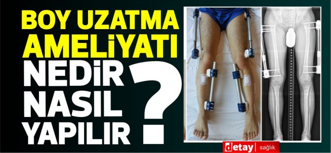 Boy uzatma ameliyatı nedir? nasıl yapılır? fiyatı nedir?