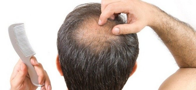 Koronavirüs'ü atlatanlarda saç dökülmesi meydana geliyor
