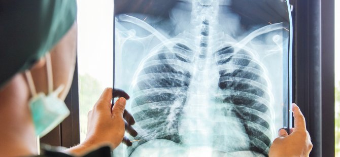 Gizli Akciğer Kanseri Vakaları Koronavirüs Nedeniyle Çekilen Tomografilerde Ortaya Çıkıyor