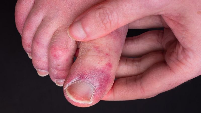 Covid: Bazı hastaların el ve ayak parmakları neden morarıyor?