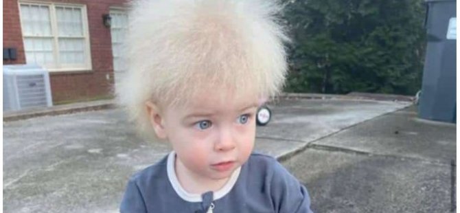 Taranamayan saç sendromu tanısı konulan bebeğe Instagram’da büyük ilgi