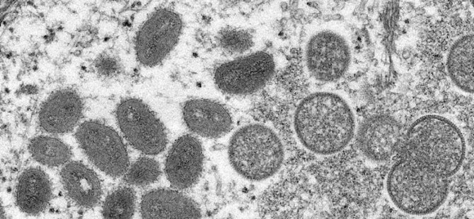 Avrupa’nın ardından ABD’de monkeypox (maymun çiçeği) virüsü alarmı