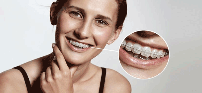 Diş teli ile ilgili 5 önemli bilgi!