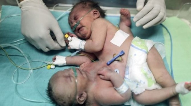 Gazzeli yapışık ikizler Suudi Arabistan'da ameliyatla ayrıldı