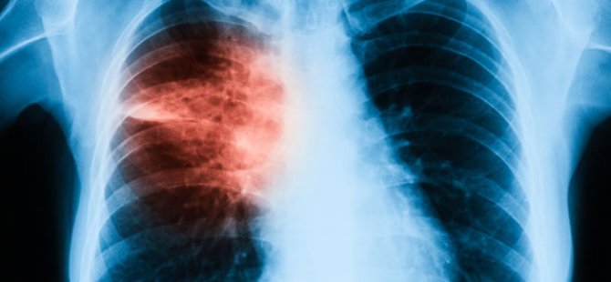 Akciğer kanserinden korunmak için 6 altın kural!