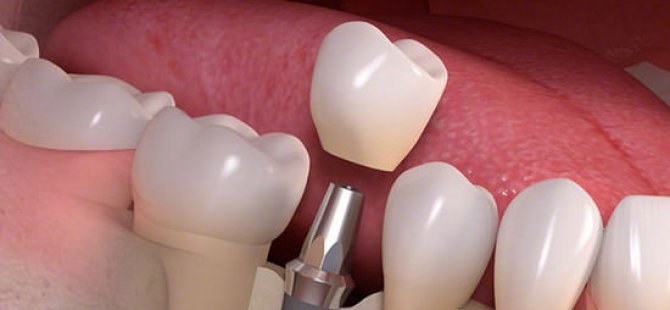 Soru Ve Cevaplarla “Dental İmplantlara” Bakış