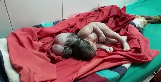 Hindistan’da üç başı olan bebek dünyaya geldi; ameliyat edilecek