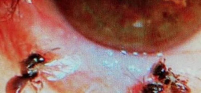 Bir Kadının Enfeksiyon Kapan Gözünden Canlı Arılar Çıkarıldı