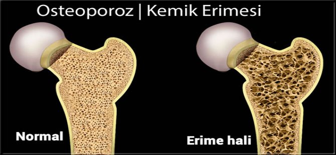 Osteoporoz “Kemik Erimesi” günümüzde önemli bir sağlık problemi