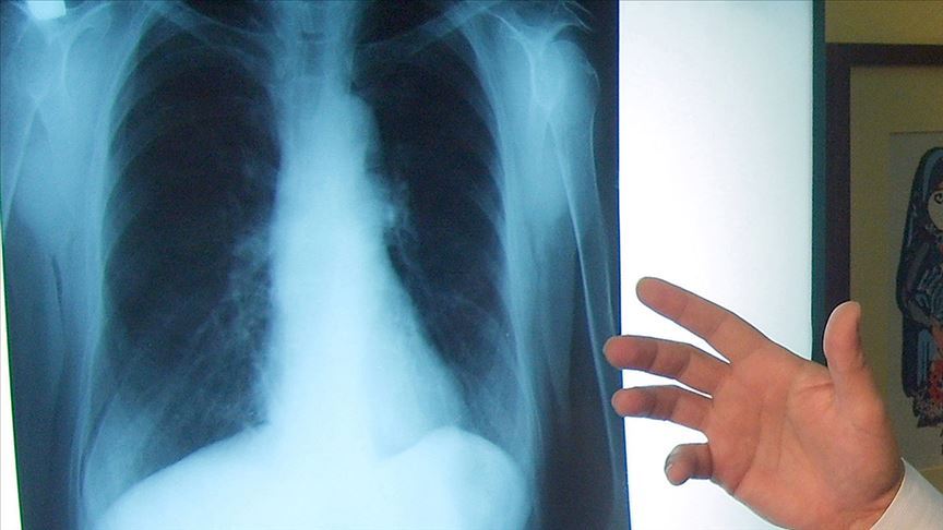 Akciğer kanserinde yeni tedavi yöntemleri sağ kalım süresini artırıyor