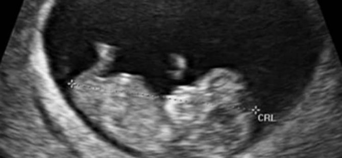 Kürtaj talep edenler fetüs ya da embriyo görüntülerine bakmaya zorlanacak