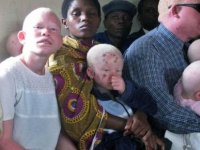 Senegal'de Albinosların Yüzde 98'i Kanser