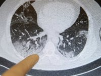 Covid-19'un akciğerlere verdiği zarar tomografi görüntülerine yansıyor