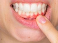 Diş Eti Enfeksiyonları Bağışıklığı Olumsuz Etkiliyor !