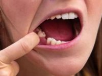 Korona Hastalarında Yeni Bulgu! Dişlerinize Dikkat