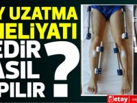 Boy uzatma ameliyatı nedir? nasıl yapılır? fiyatı nedir?