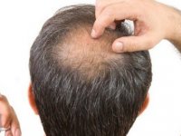 Koronavirüs'ü atlatanlarda saç dökülmesi meydana geliyor