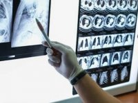Akciğer kanseri için umut ışığı: Hastalığın gidişatı değişebilir