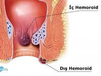 İşte hemoroid hastalığının en kolay tedavisi
