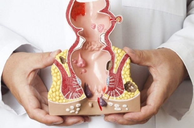 Hemoroitten korunmanın 8 yolu galerisi resim 11