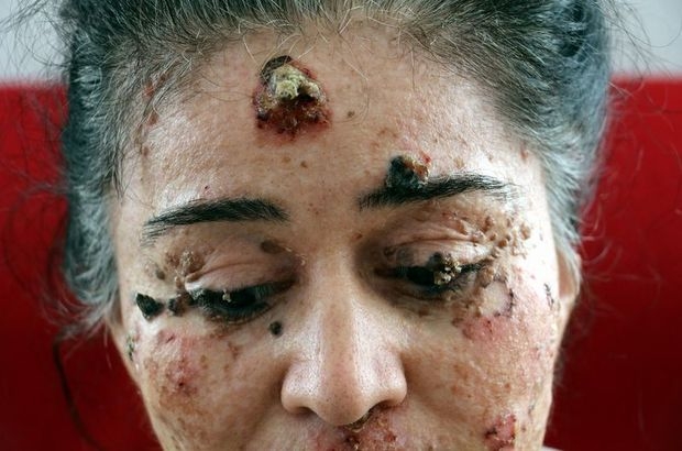 Güneşe çıktıkça eriyor. Hastalığını araştırıyorlar galerisi resim 2