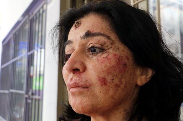 Güneşe çıktıkça eriyor. Hastalığını araştırıyorlar galerisi resim 3