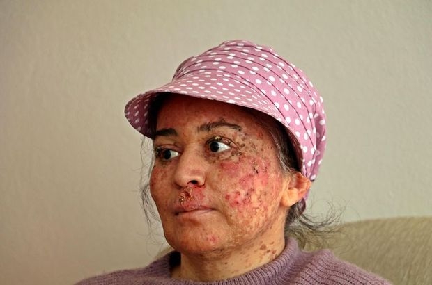 Güneşe çıktıkça eriyor. Hastalığını araştırıyorlar galerisi resim 7