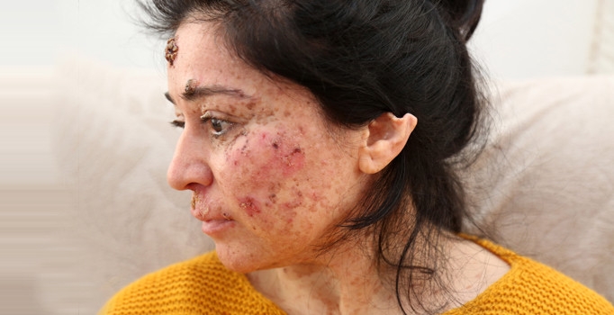 Güneşe çıktıkça eriyor. Hastalığını araştırıyorlar galerisi resim 9