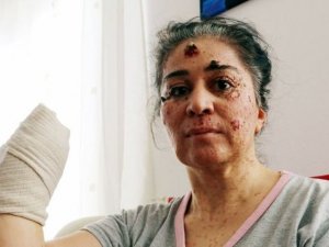 Güneşe çıktıkça eriyor. Hastalığını araştırıyorlar