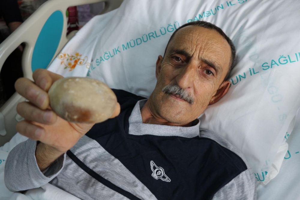 Patates sandılar.Hastanın karnından çıkınca doktor da şaşkına döndü galerisi resim 11