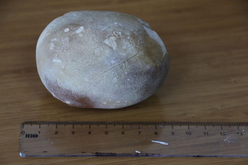 Patates sandılar.Hastanın karnından çıkınca doktor da şaşkına döndü galerisi resim 2