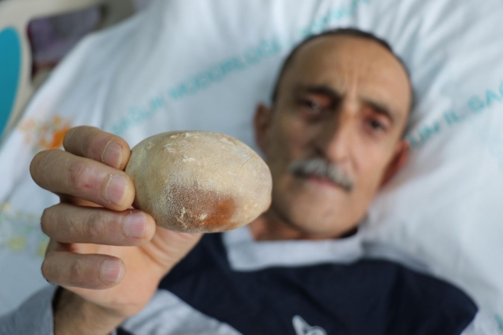 Patates sandılar.Hastanın karnından çıkınca doktor da şaşkına döndü galerisi resim 6