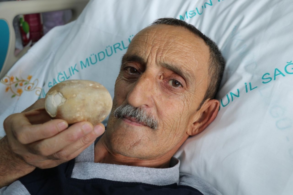 Patates sandılar.Hastanın karnından çıkınca doktor da şaşkına döndü galerisi resim 7