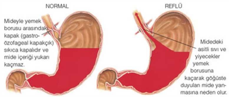 Reflü şikayetlerini azaltmanın 10 altın kuralı galerisi resim 11